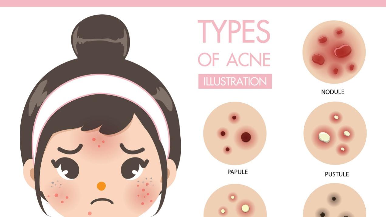 青春期脸上痘痘严重怎么办，不治疗会留疤吗？