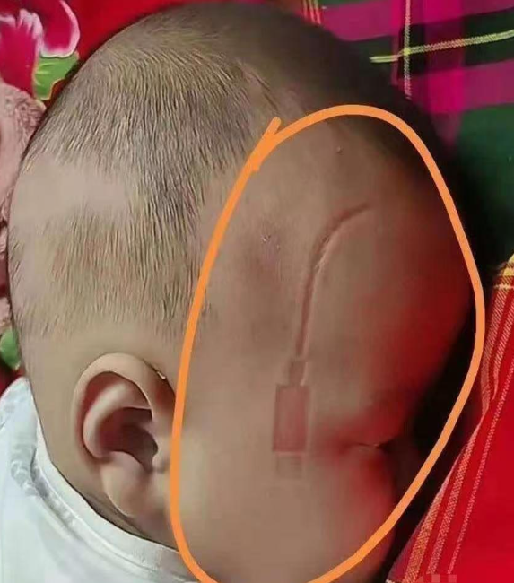 医生说：如果再多压三四个小时，这个充电器印子就永久性去不掉了，将会陪伴孩子一辈子