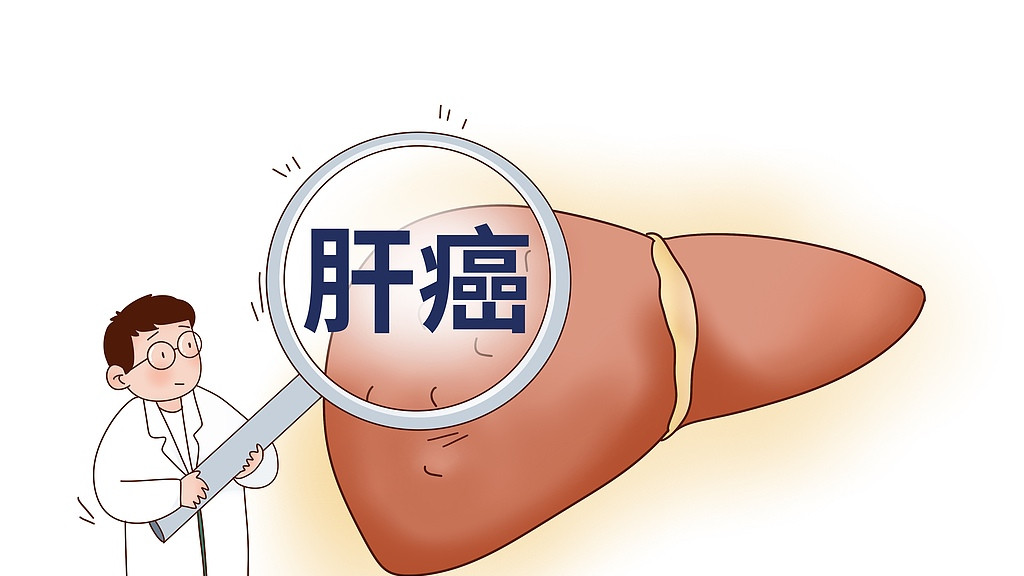 警惕肝癌腹水：早期识别与干预的关键