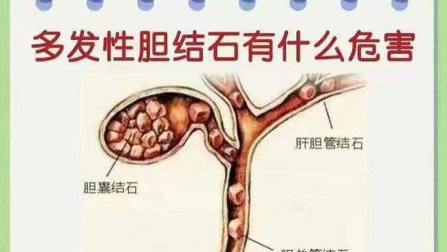 虹济胆结石孙主任：重视体内胆结石炸弹