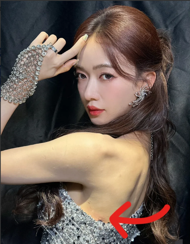 吴谨言后背长了个脓包，提裙子都小心翼翼的！

脓包要是爆了，礼服得脏，那可赔不起