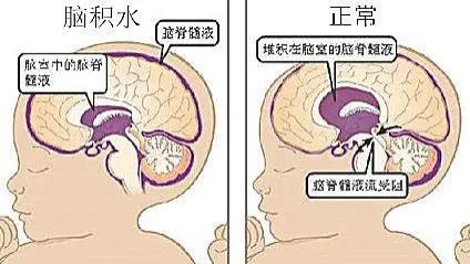 脑积水对智力有影响吗？