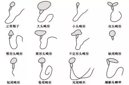 、正常形态精子百分率降低（畸精）等，尤以少弱畸形精子症临床常见 。