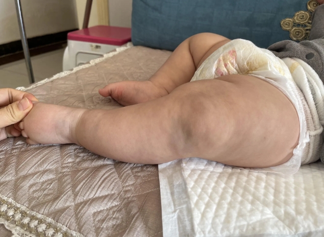 被弟媳莫名其妙骂了一顿……也是够了，6个月的娃25斤，看看这个腿就不正常啊，我就