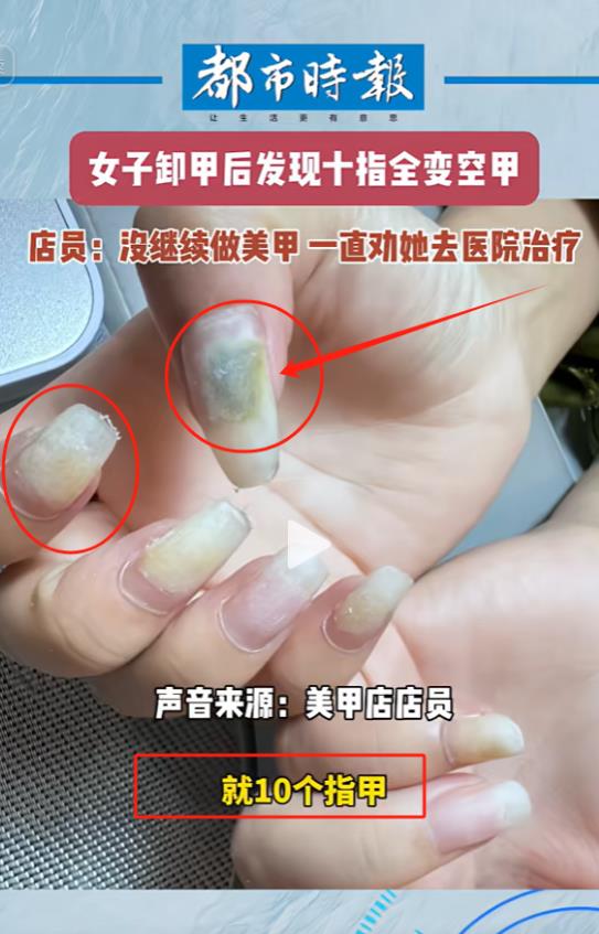 “这就是美丽的代价！”云南，女子到美甲店卸掉美甲准备再做时，发现十个指甲长满绿脓