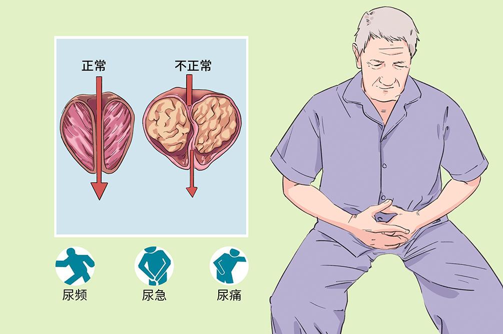 前列腺炎就像感冒一样？