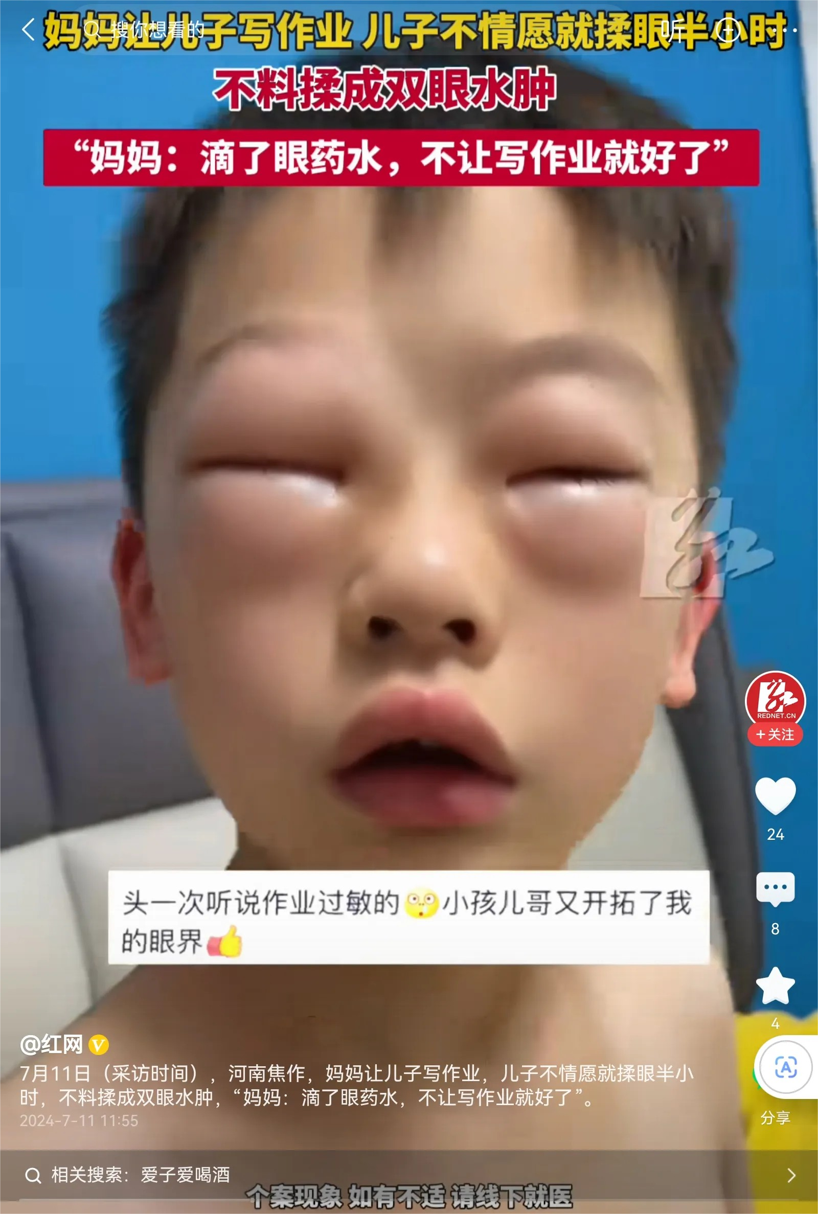 男孩为了不写作业，他竟然揉眼半小时，把两个眼睛都揉肿了。这样做太吓人了，这么小的