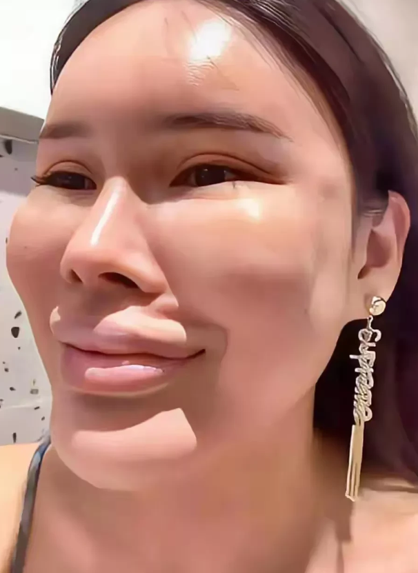 不可思议！上海，有一名年轻的女子因为嫌弃自己的脸太大，花光了自己积蓄，来到医院对