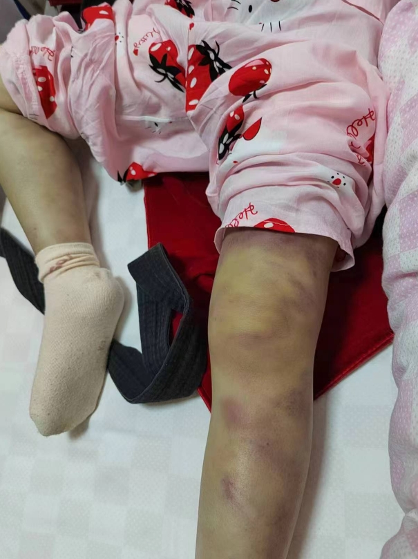 “太恶毒了！”重庆，一6岁女童被姑奶奶紧急送医抢救，她的身上有多处骨折、脑部还严