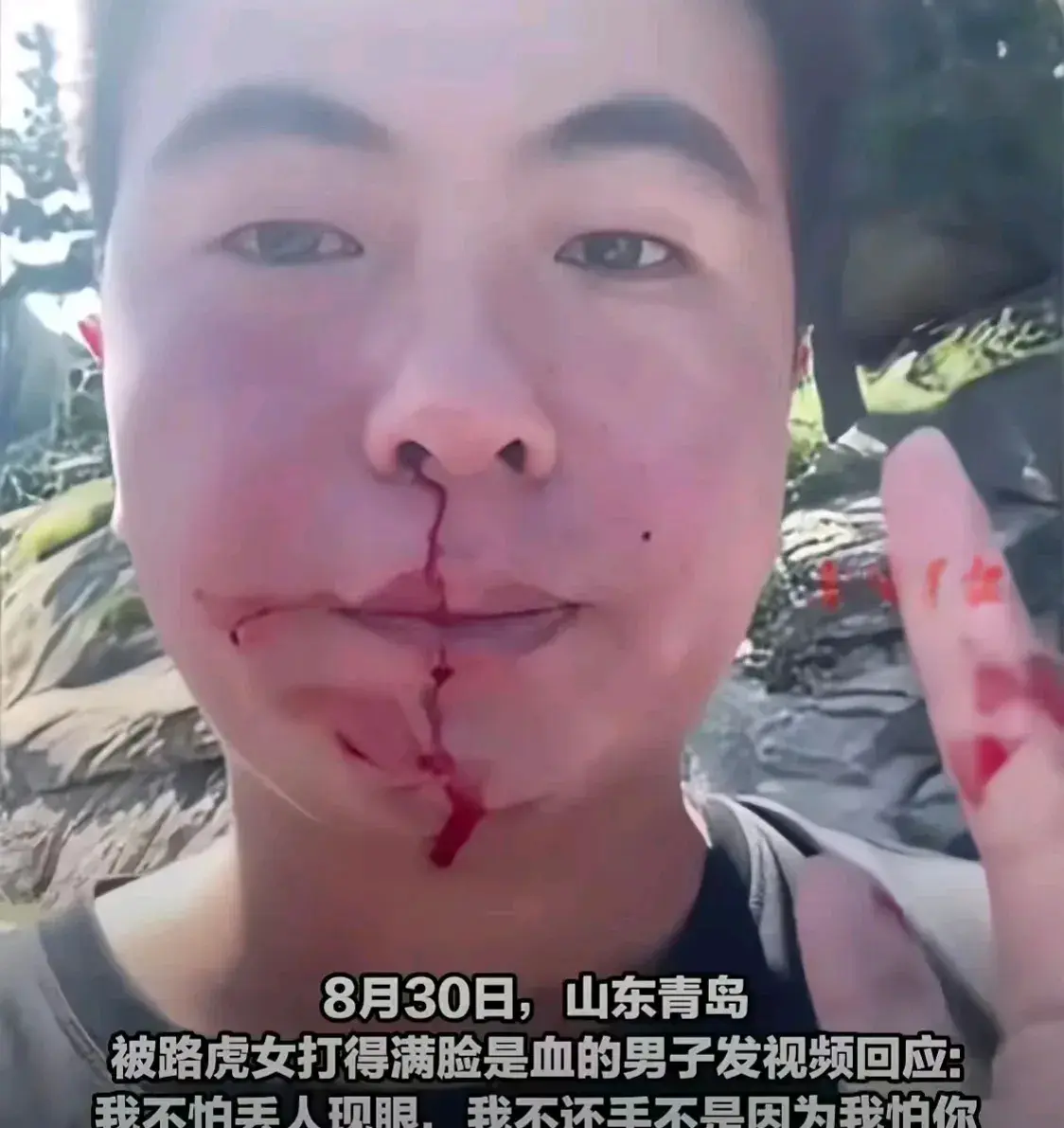 青岛男子被殴打住院后，首次发声，主要表达了6点：

1，他现在住在医院里，经常头