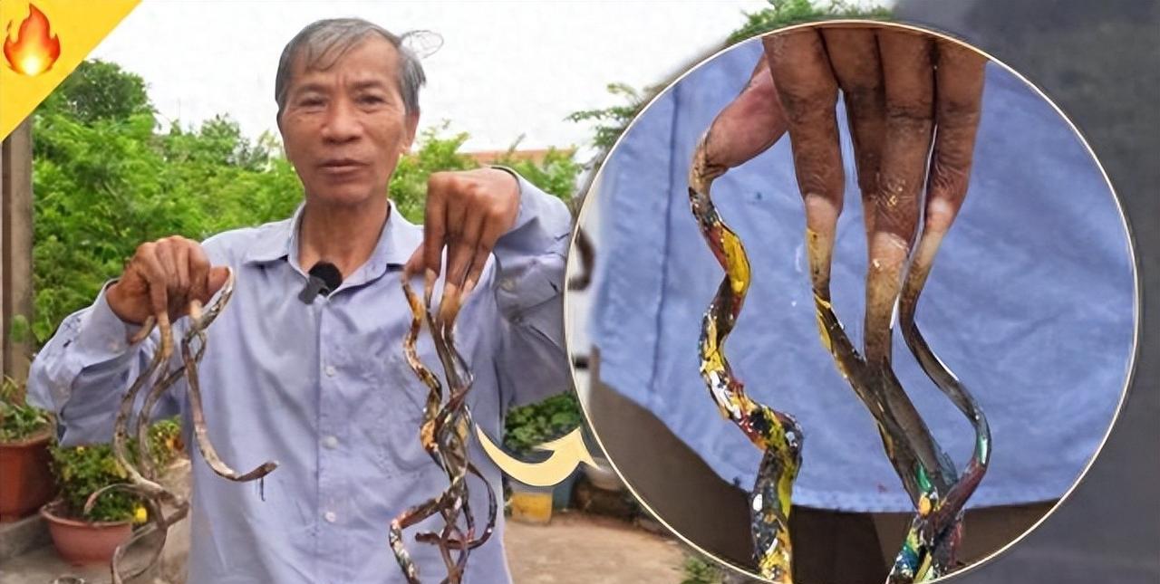 太恶心：66岁大爷33年没剪指甲，也没洗过手，洗澡穿衣都要靠妻子
今天必须给你们