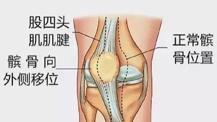 髌骨脱位了怎么办？！康复练习法有哪些（图文解说）