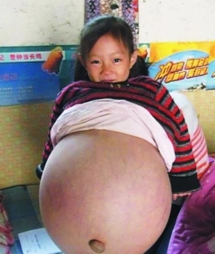 山西一个贫困家庭中的4岁小女孩小云，因莫名其妙的怪病困扰多年，肚子胀得像临产的孕