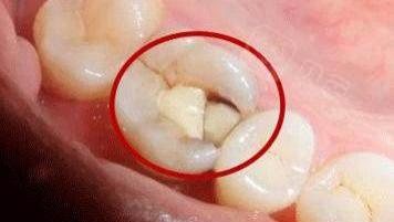 牙齿一到夏天就隐隐阵痛？牙齿出现这4种表现，别不当回事，这或说明牙龈出现萎缩了！