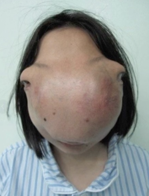 2009年，22岁浙江女孩因长了一张怪脸，蒙面生活13年后，好不容易凑够了医药费