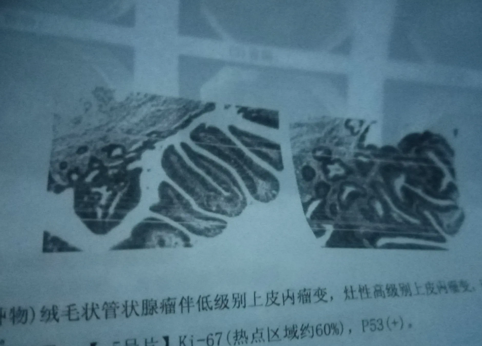 老百姓实在是生不起病！在市医院做了一个肠息肉，就花费了不到两万元！这还是除去报销