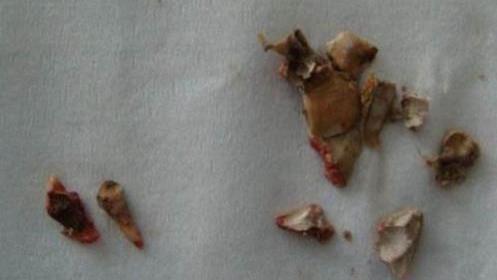 牙齿上长“石头”，味道又臭又腥，教你一招解决！