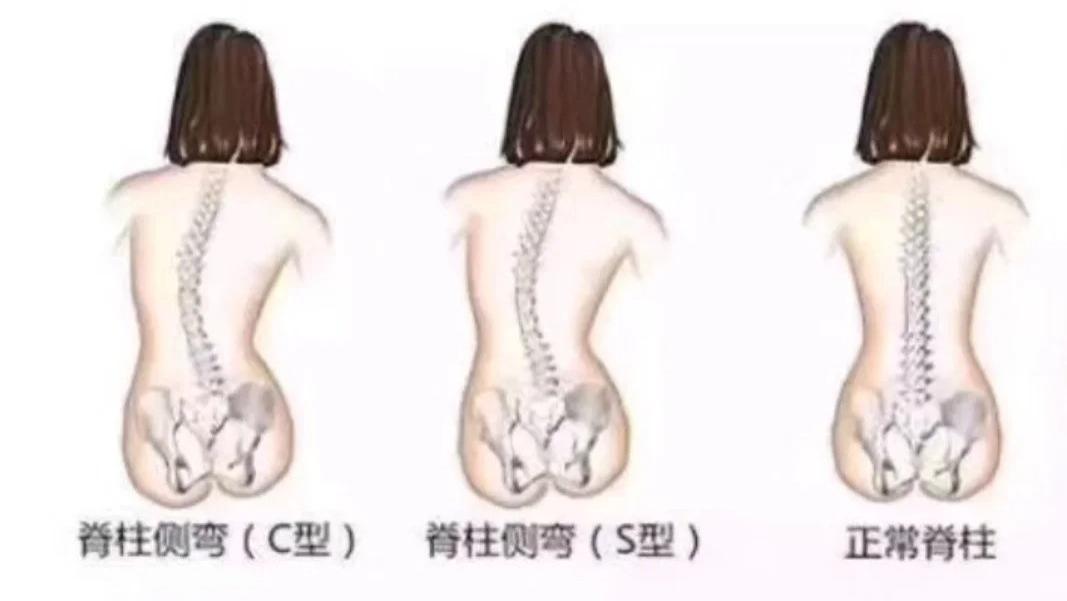 《华脊道青少年体态健康：脊柱弯曲异常（S、C 型侧弯）的危害》