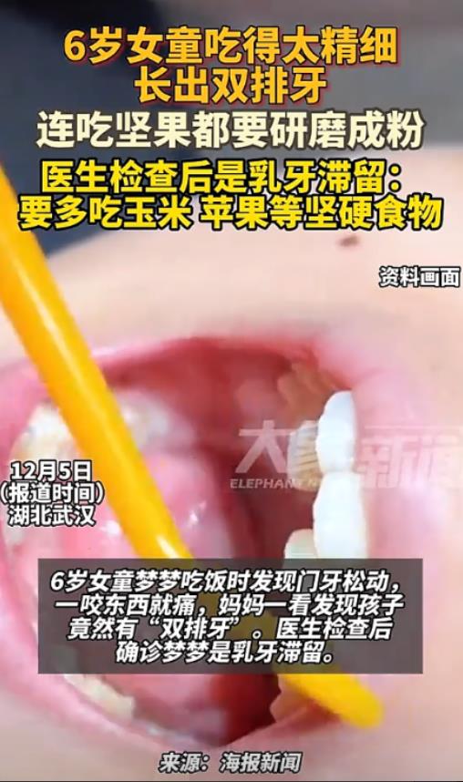 六岁女童长了双排牙，这到底是因为啥呢？

在湖北武汉，一个六岁的小女孩在吃饭的时