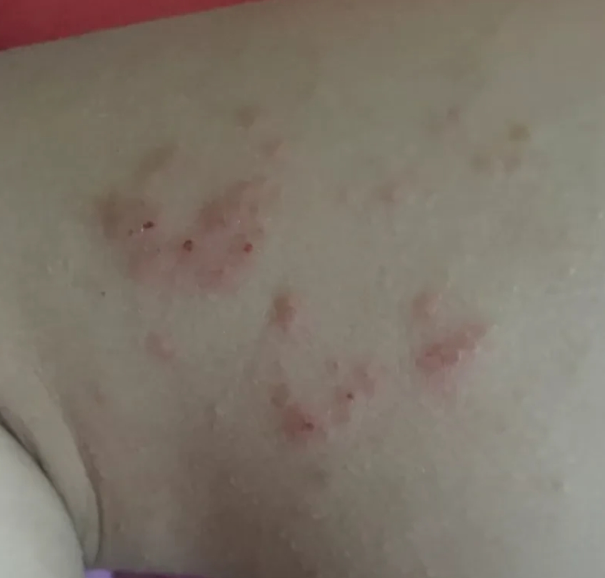 有没有人知道这是怎么了？

一岁八个月的宝宝痒得一直挠，都挠破了还觉得痒。

婆