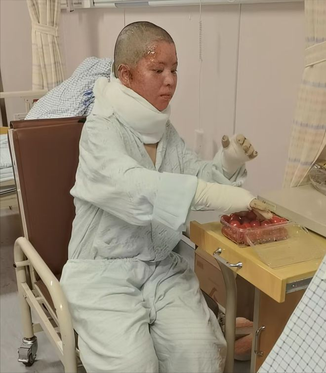 “烧伤妈妈”一家三口团聚，这是烧伤妈妈手术后第一次抱儿子，目前来看儿子并没有收到
