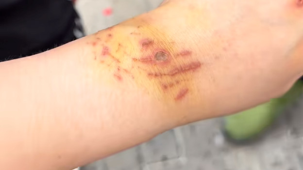 生理期潜水追鲨鱼拍照，女子被咬后笑称“涂碘伏就行”，如今面临截肢风险！