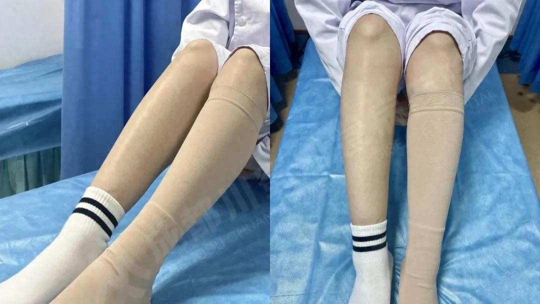 穿静脉曲张袜后瘙痒难受？实用应对方法分享