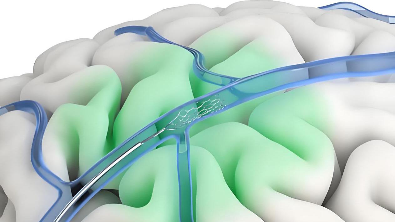 陈根：把脑机接口“打进血管”，意味着什么？