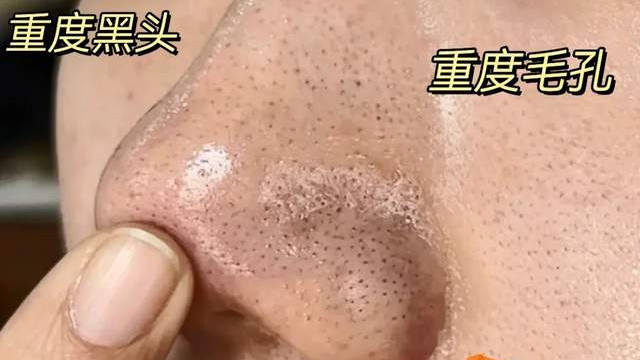 皮肤出油长黑头闭口，怎么办？