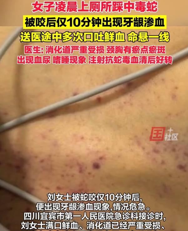 太吓人了！云南昭通，女子凌晨去上厕所，下地刚走两步就踩中一条毒蛇，自己也因此被咬