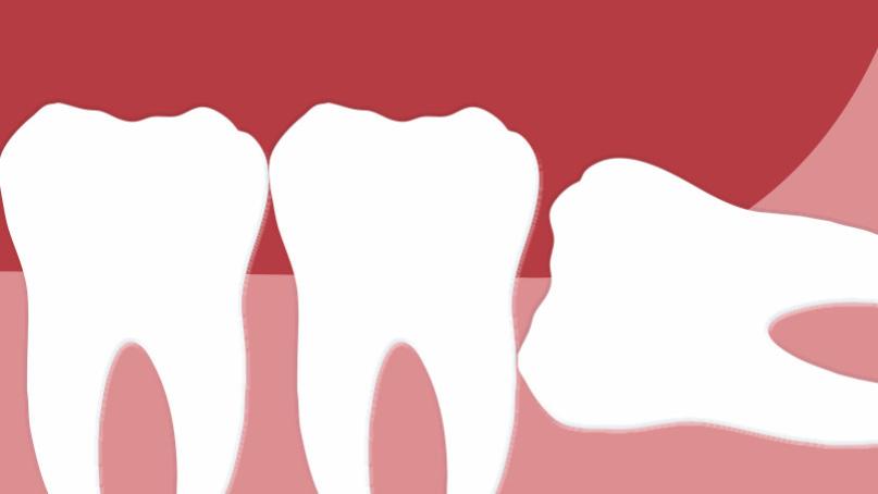备孕必须拔智齿吗？牙医建议这3种情况及早处理