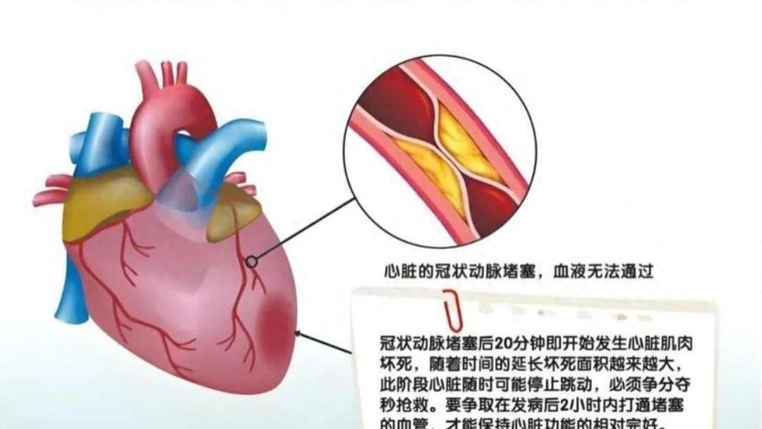 够预防心梗的三个中成药: 通心络胶囊，麝香保心丸，诺迪康胶囊