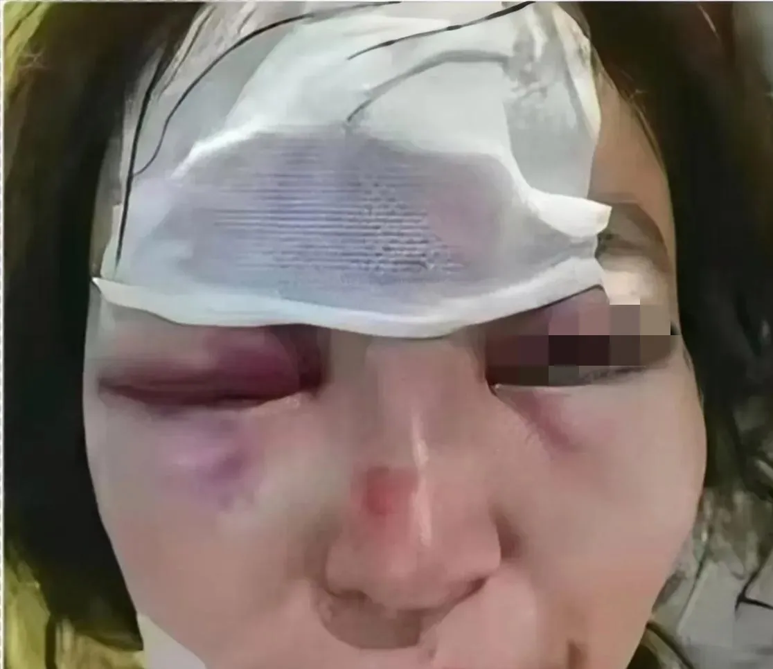 第一次家暴，我的脸直接被老公扇成猪头，眼睛都睁不开，在家整整五天，无人问津。婆婆
