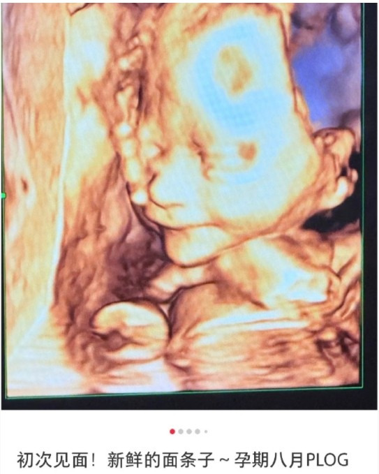 包文婧怀二胎八个月了











天哪！包文婧居然怀二胎8个月了！她竟