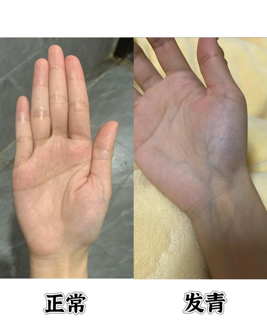 大鱼际发青是不对的，解答粉丝留言的问题。
临床我就发现有咳嗽的小患者，仔细一看手