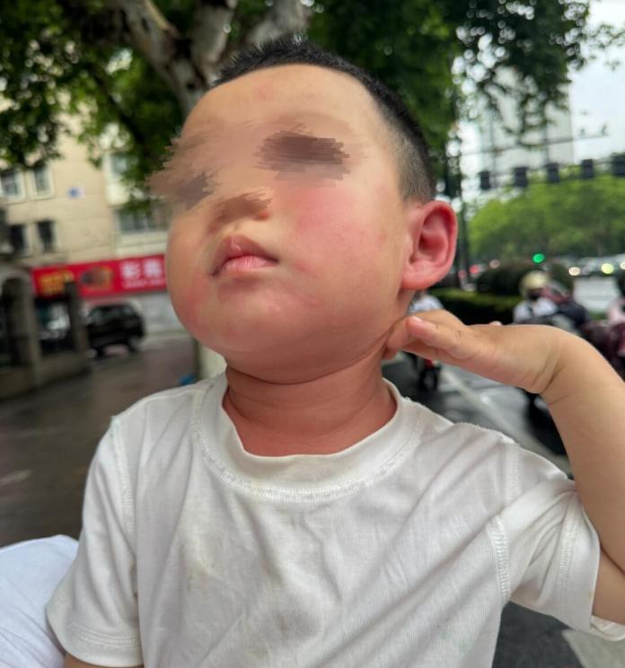 防不胜防！6月9日，有市民发帖称，在她入住浙江某豪华酒店时，孩子被屋内的蚊虫叮咬
