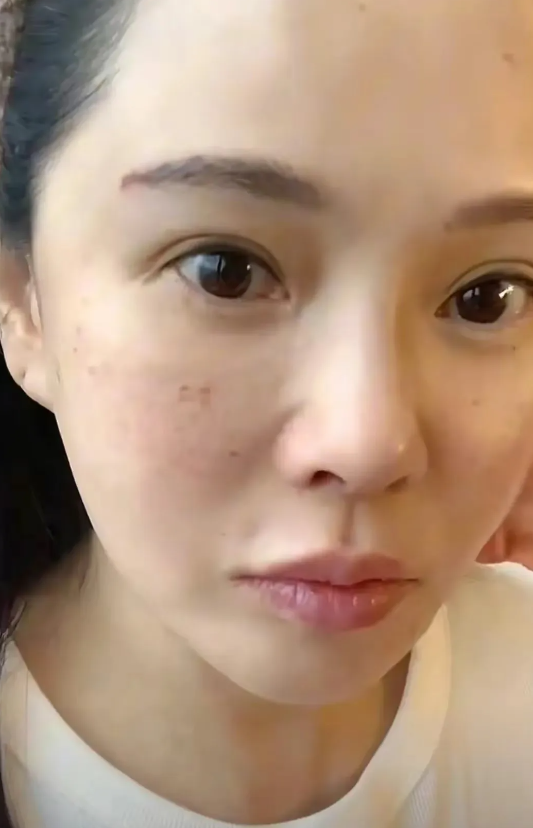 伊能静为了美真的是很拼，56岁的她跑去韩国打水光针，满脸都是针眼看着都疼。
不过