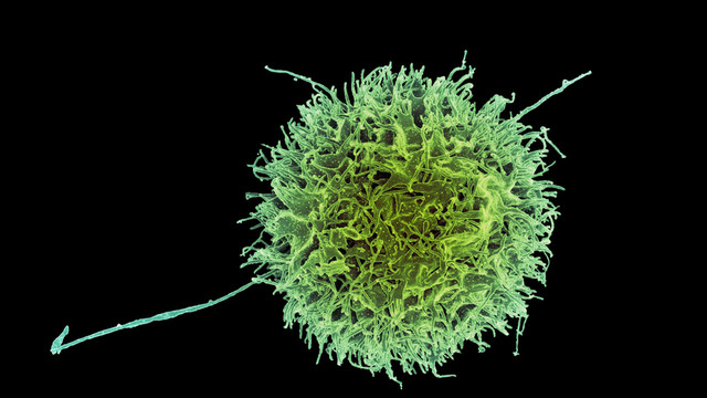 持续完全缓解15个月！现成CAR-NK细胞疗法，100%疾病控制，安全更省时，多领域显效