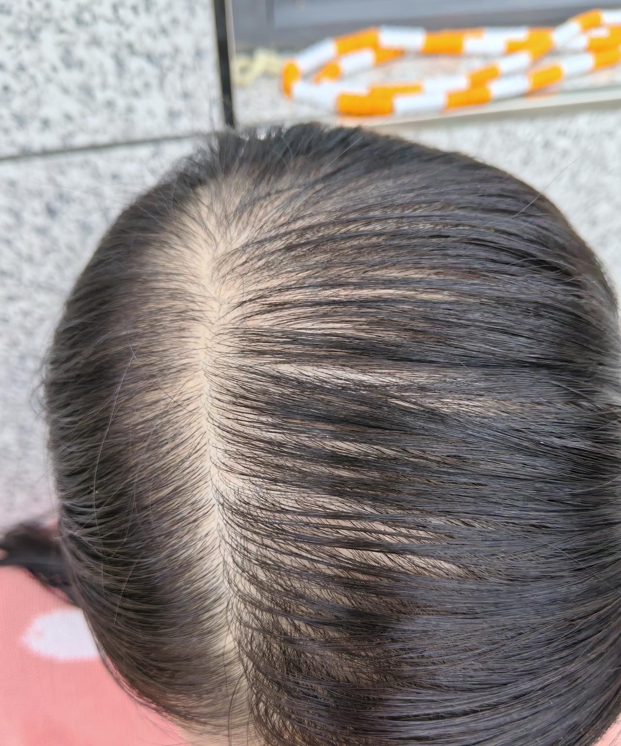 35岁的年纪，头发掉的稀疏的，孩子爸天天叫我仇千尺，不说让我去医院看看，天天不是