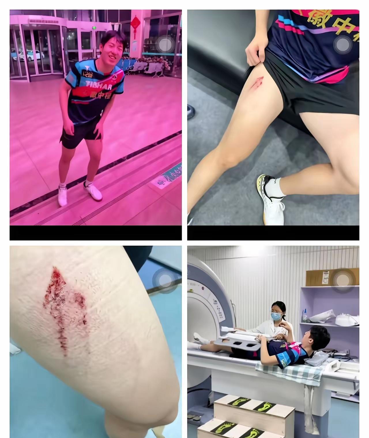 乒超联赛，国乒小将温瑞博报平安，伤的皮肉伤无大问题，球迷可放心。昨天和许昕的单打