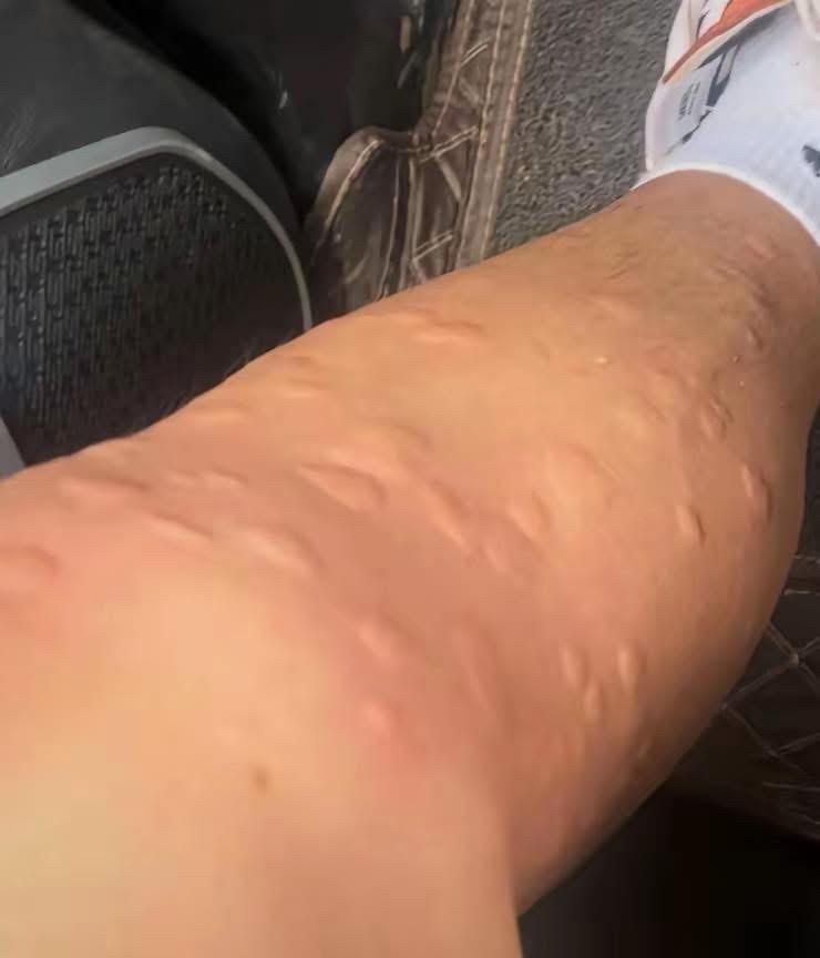 现在蚊子是变异了吗？
我的妈呀太痒了，真是要命了，这腿又不能不要了，在山里没有花