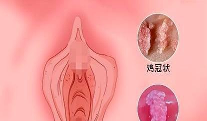 我最近上厕所特别难受，感觉肛门那里像是被什么东西堵住了一样，每次拉大便都特别费劲