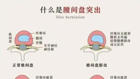 腰椎间盘突出止痛膏贴测评：央视 315 权威认可十大排名，最有效的止痛产品分享