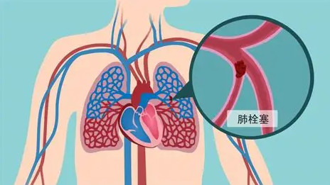 瘀血型肺心病照护者手册：做好这些，帮家人少受病痛折磨