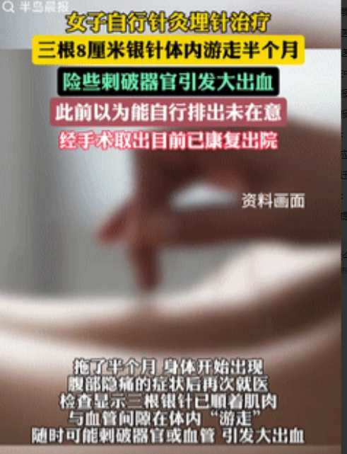 6月10日，辽宁一女子自学针灸，自己埋了三根8厘米长的银针，不料针竟深入体内，她