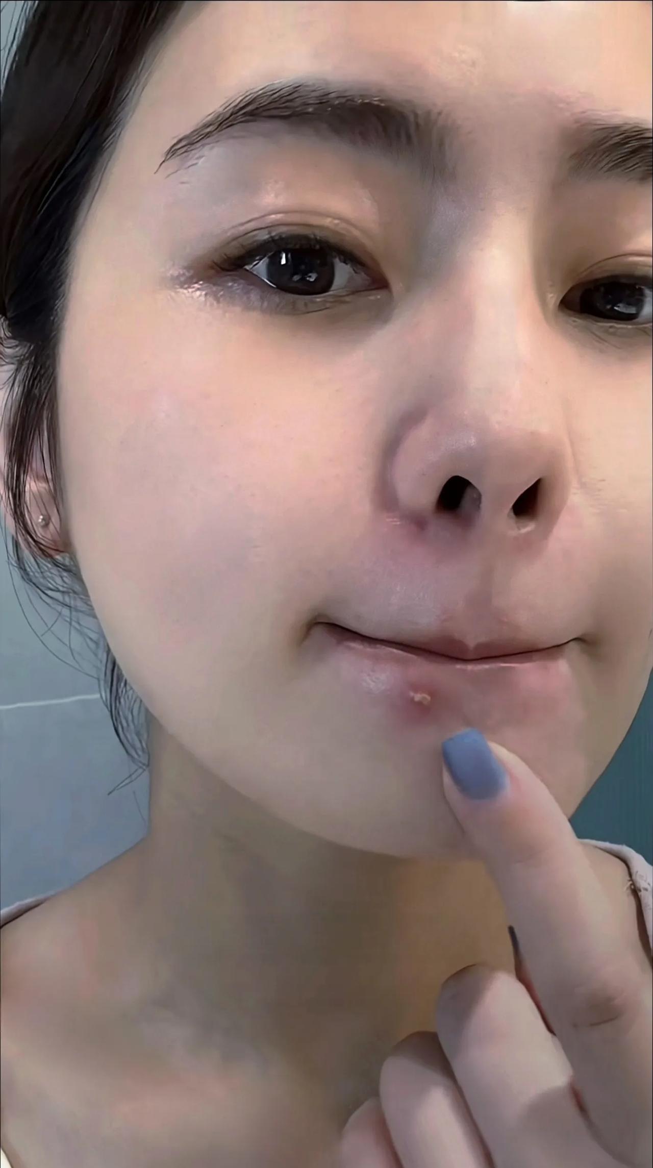 快点结婚吧！结婚了你的痘痘就好了！
这是我长痘后听到的最多的一句话！
难道男人对