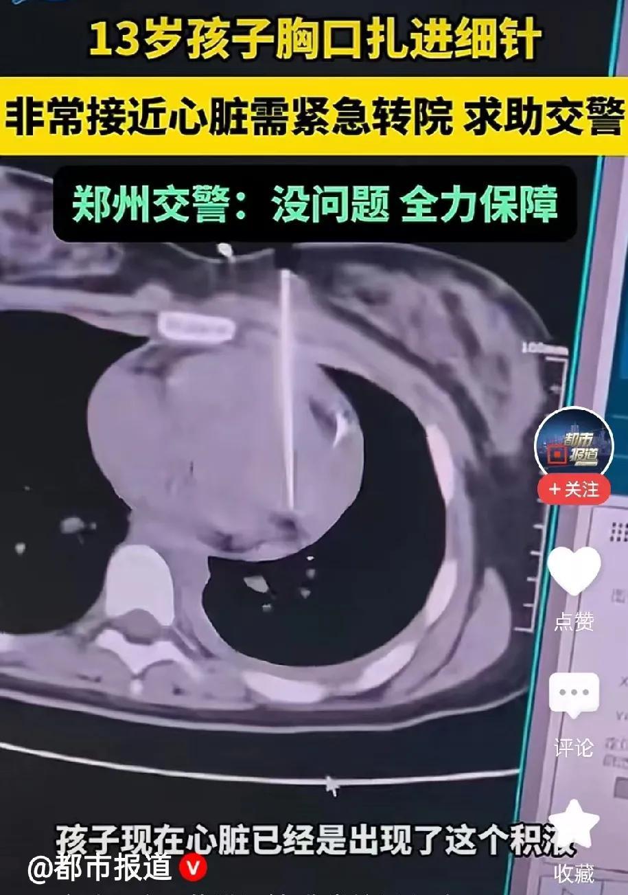 13岁孩子胸口扎进细针
情况危急！！！
郑州交警全力保障孩子转院路上交通
郑州一