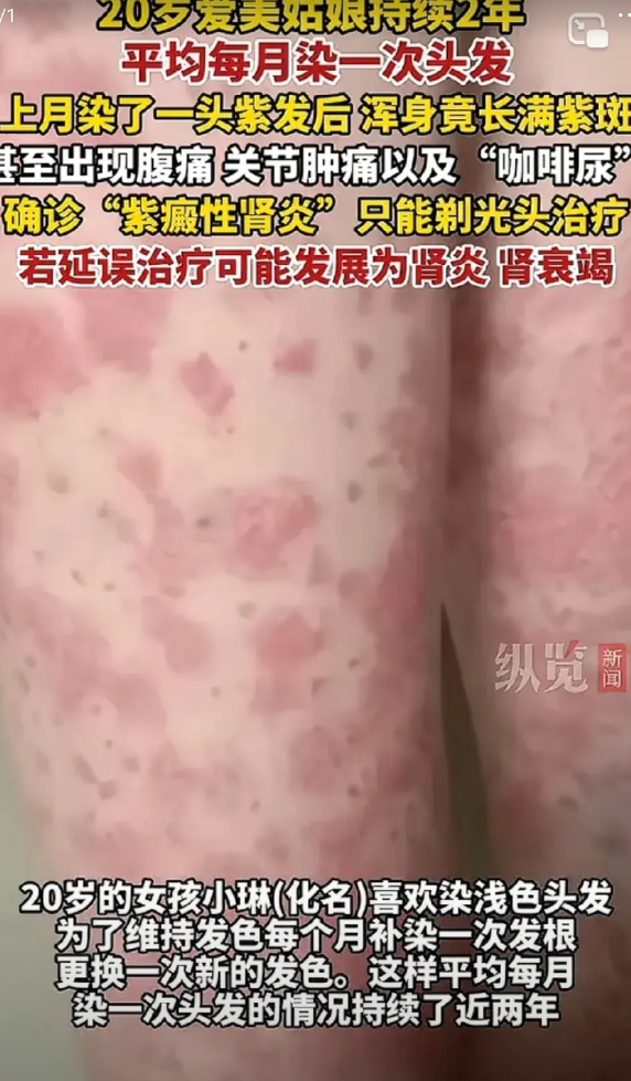 我也是每月染发的女生，看到最近00后频繁漂染导致肾炎的新闻，真觉得无语。

谁还