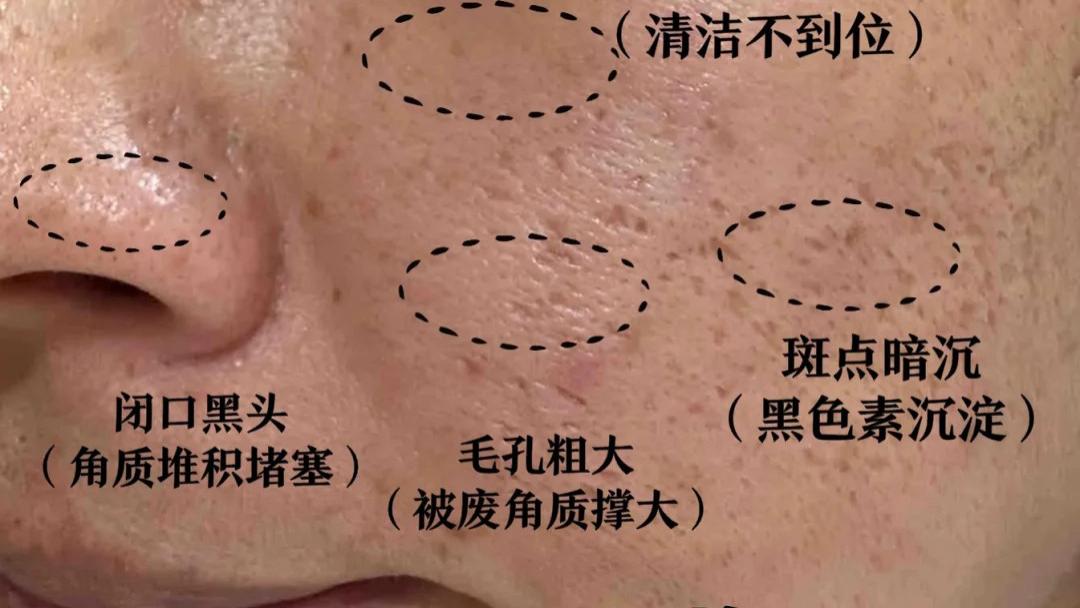 敏感肌也能细腻毛孔？油敏肌毛孔粗大修复全攻略