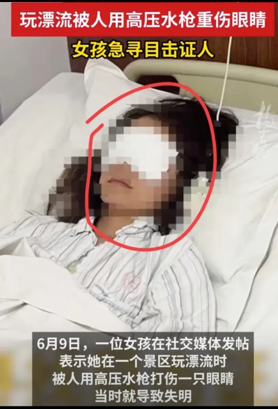 女孩6月7日在山东潍坊玩漂流，竟然被人用水枪攻击右眼挫伤积血！

肇事者打伤他的